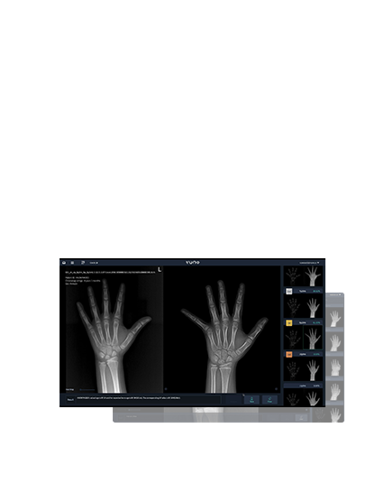 Vuno Med Bone Age인공지능 성장 검사